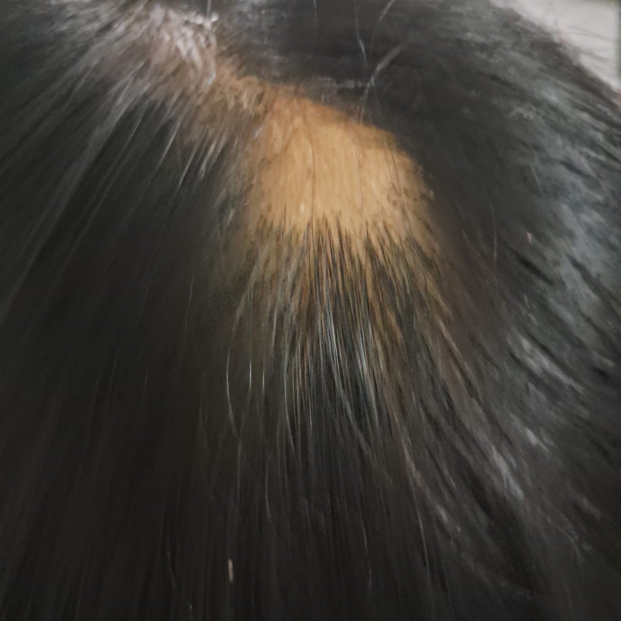 Alopecia Areata 1